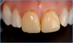 cnt-veneers-1