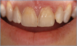 cnt-veneers-2