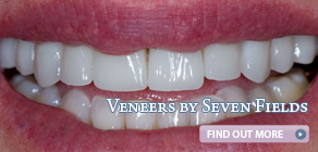 ad-veneers