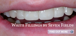 ad-white-fillings